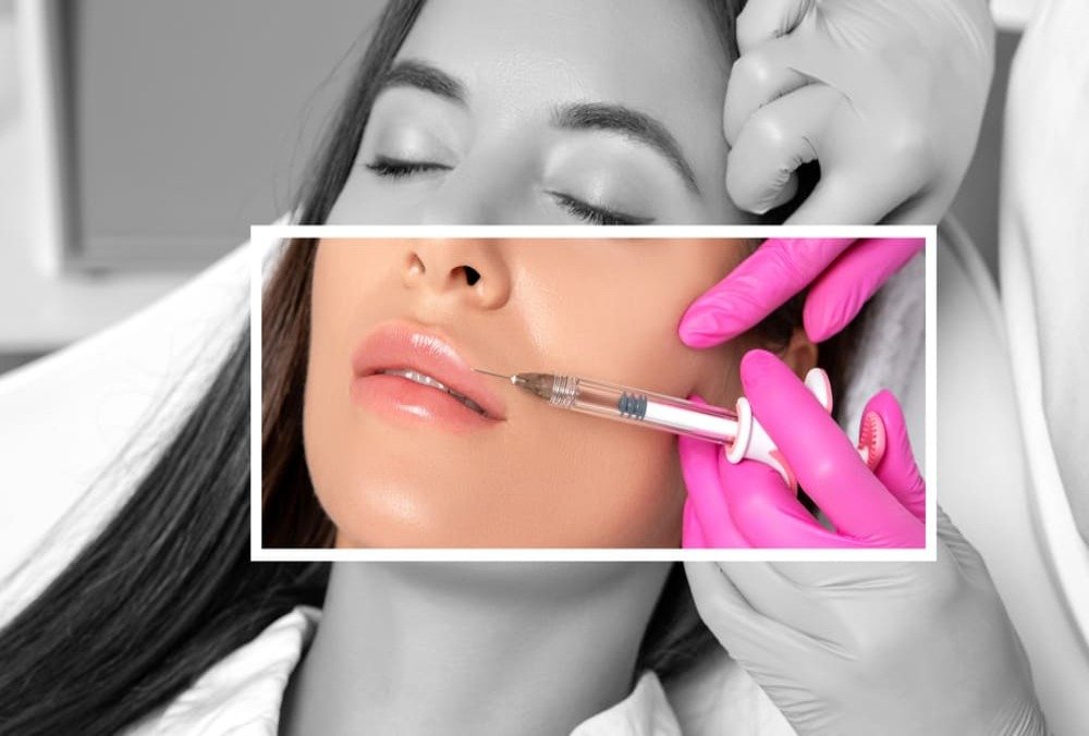 Relleno de Labios con Ácido Hialurónico en Madrid