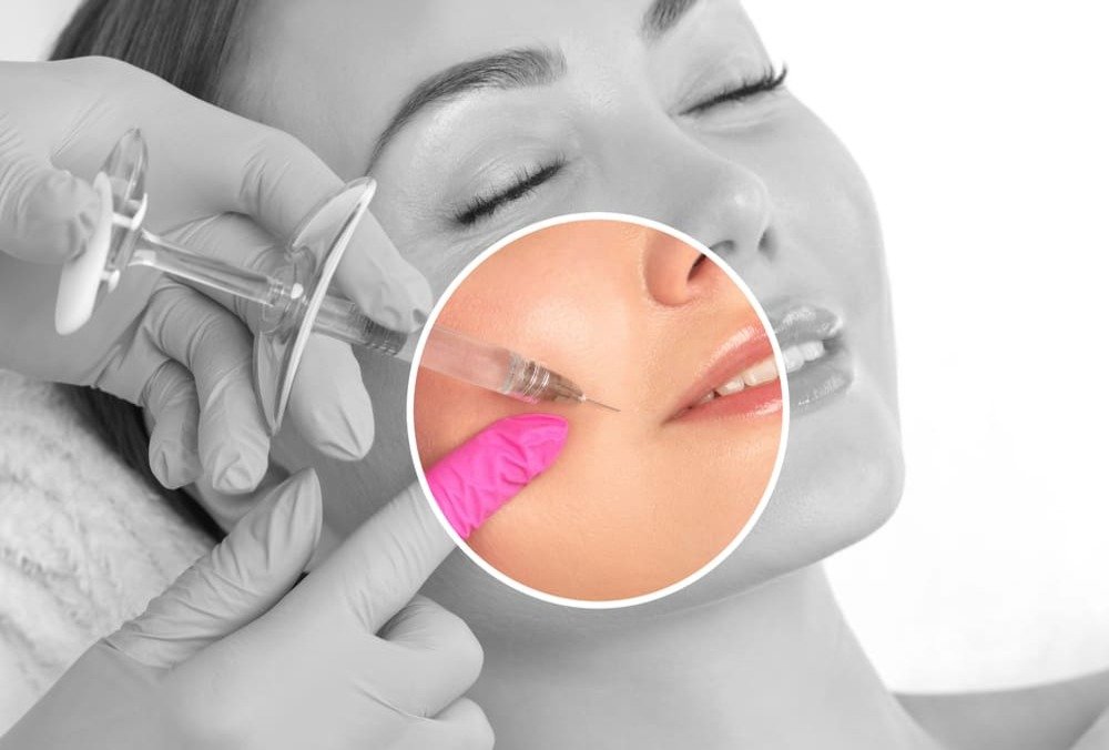 Relleno de Surco Nasogeniano con Ácido Hialurónico en Madrid